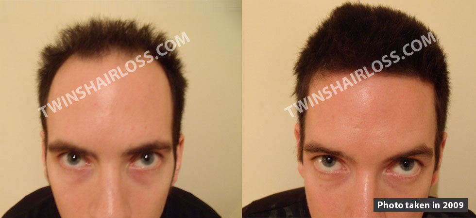 regrow thicker hair naturally